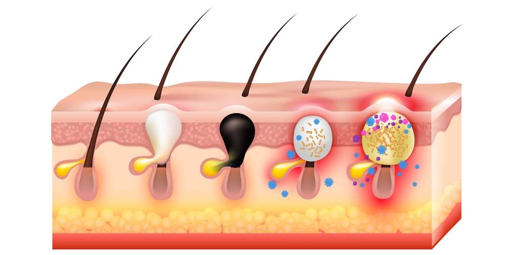 Development of Adult Hormonal Acne