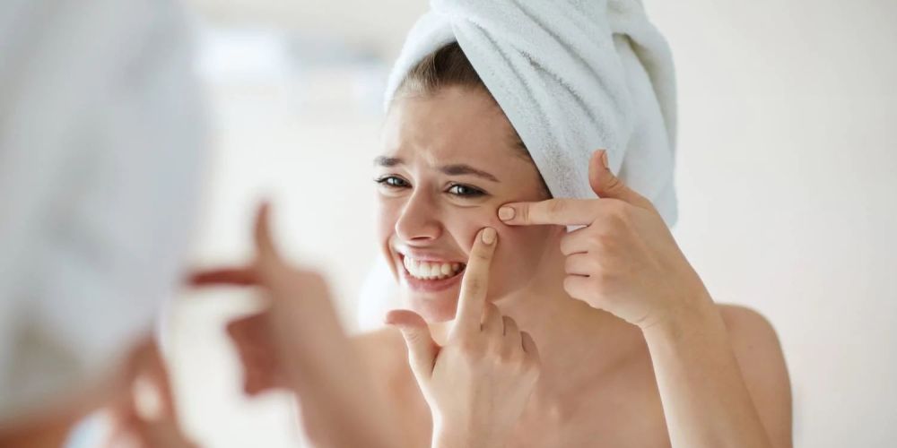 Avoid Acne Squeezing!